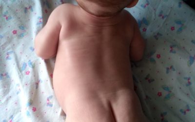 Асимметрия мышечного тонуса у младенца