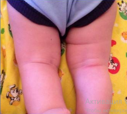 Распространённые причины несимметричных складок на ножках ребёнка